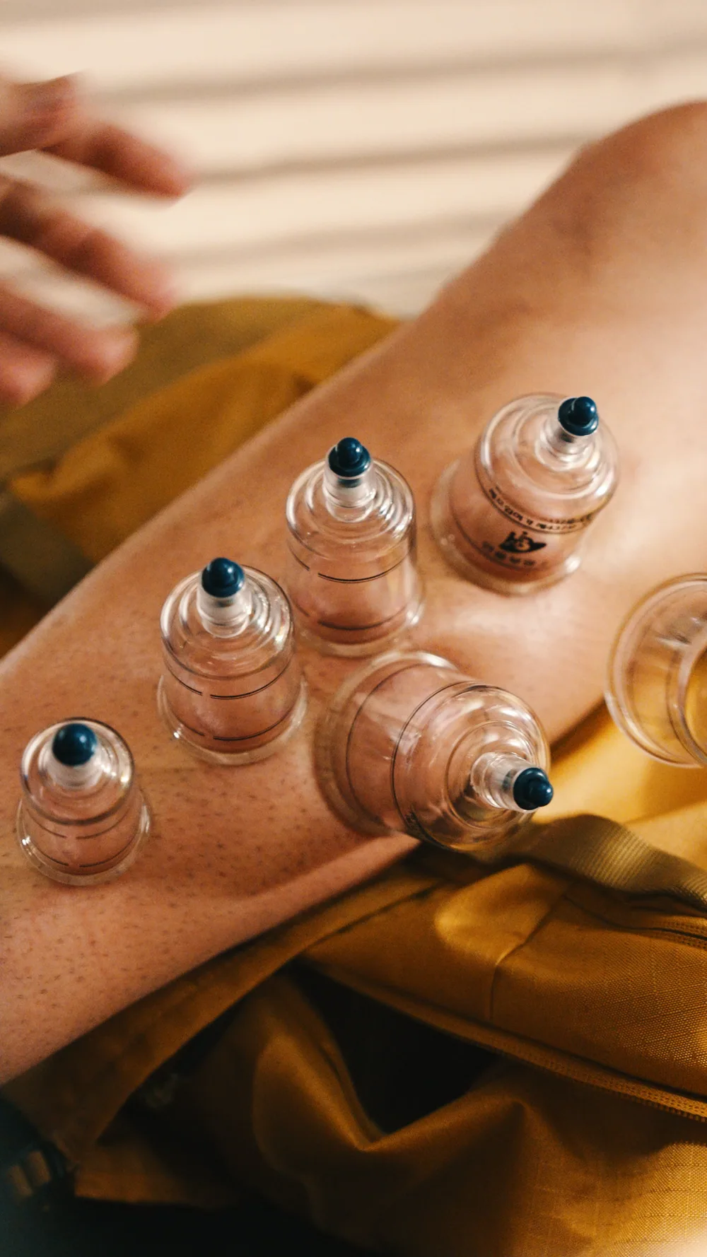Glass cupping therapy cups on a patient’s back.